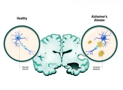 Accompagnement Alzheimer & Parkinson
